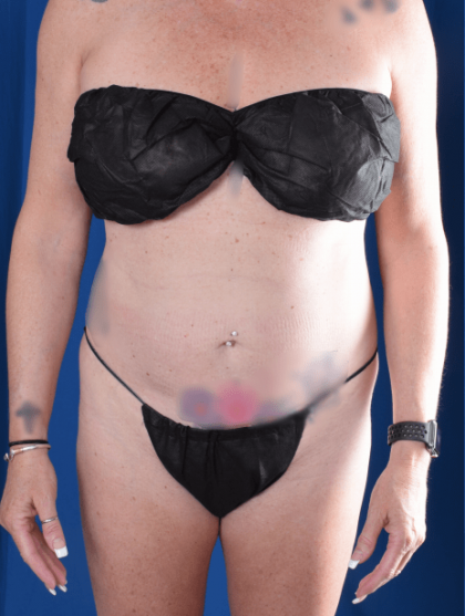 Patient #1376 Liposuction Before and After Photos Denver, CO